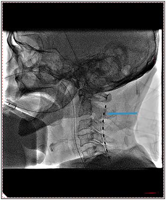 Clinical effect of short-term spinal cord stimulation in the treatment of patients with primary brainstem hemorrhage-induced disorders of consciousness